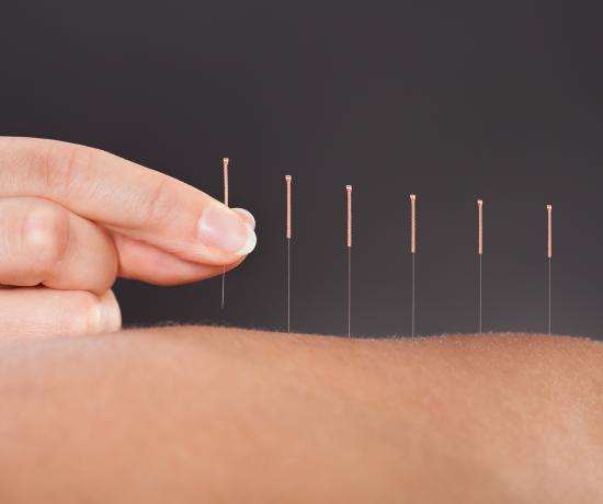 Acupuncture for endo pain relief