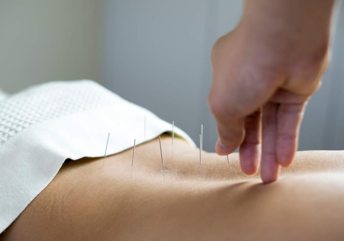 Acupuncture for endo
