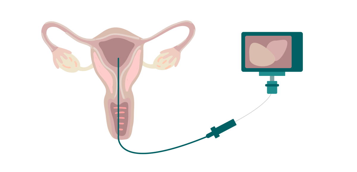 Hysteroscopy camera