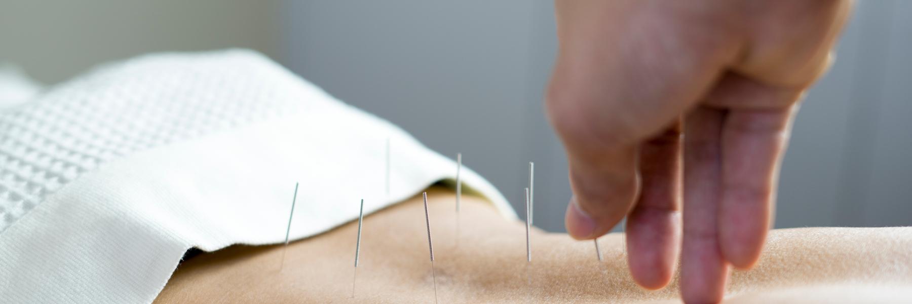 Acupuncture for endo