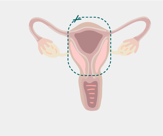 Hysterectomy