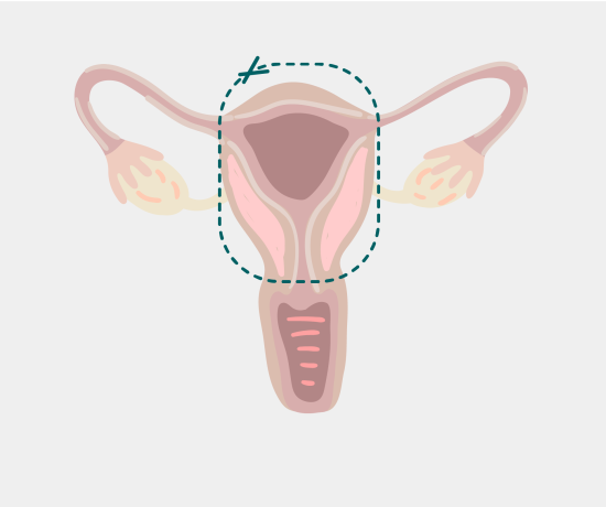 Hysterectomy