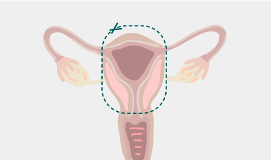 Hysterectomy