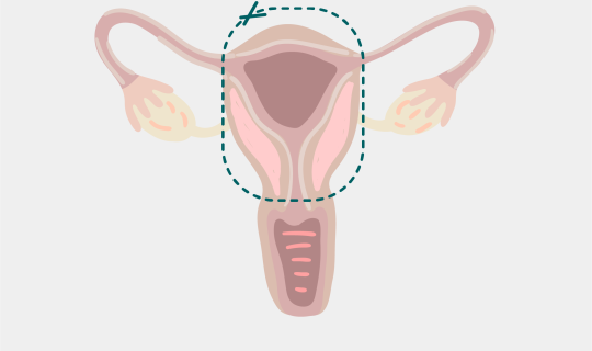 Hysterectomy