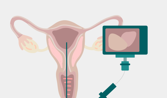 Hysteroscopy camera