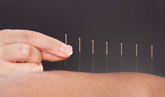Acupuncture for endo pain relief